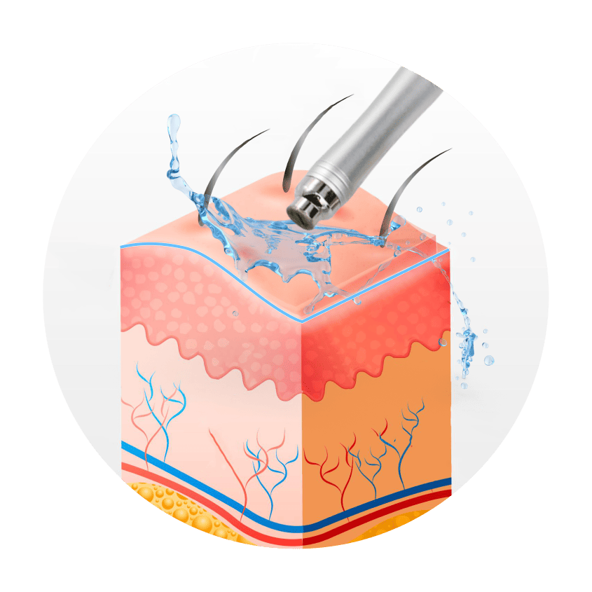 Fluid HydroDermabrasion illustration