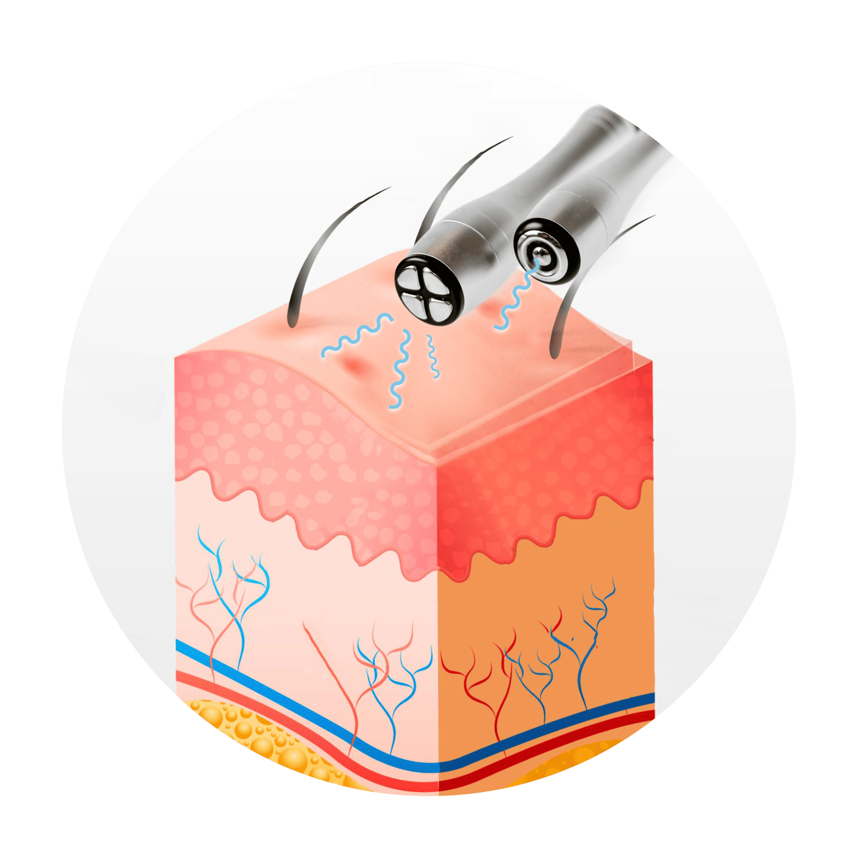 RadioFrequency Skin Tightening illustration