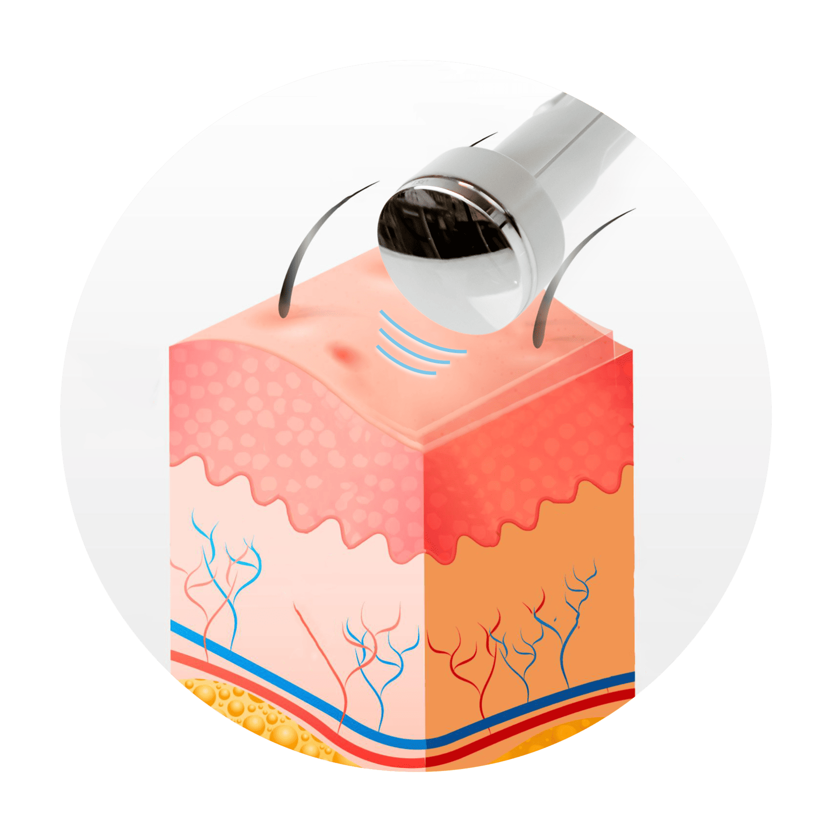 Ultrasound Therapy illustration