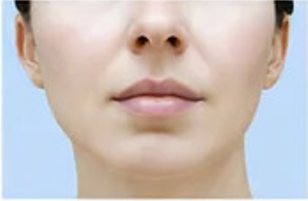 After V-Line Lift Facial treatment